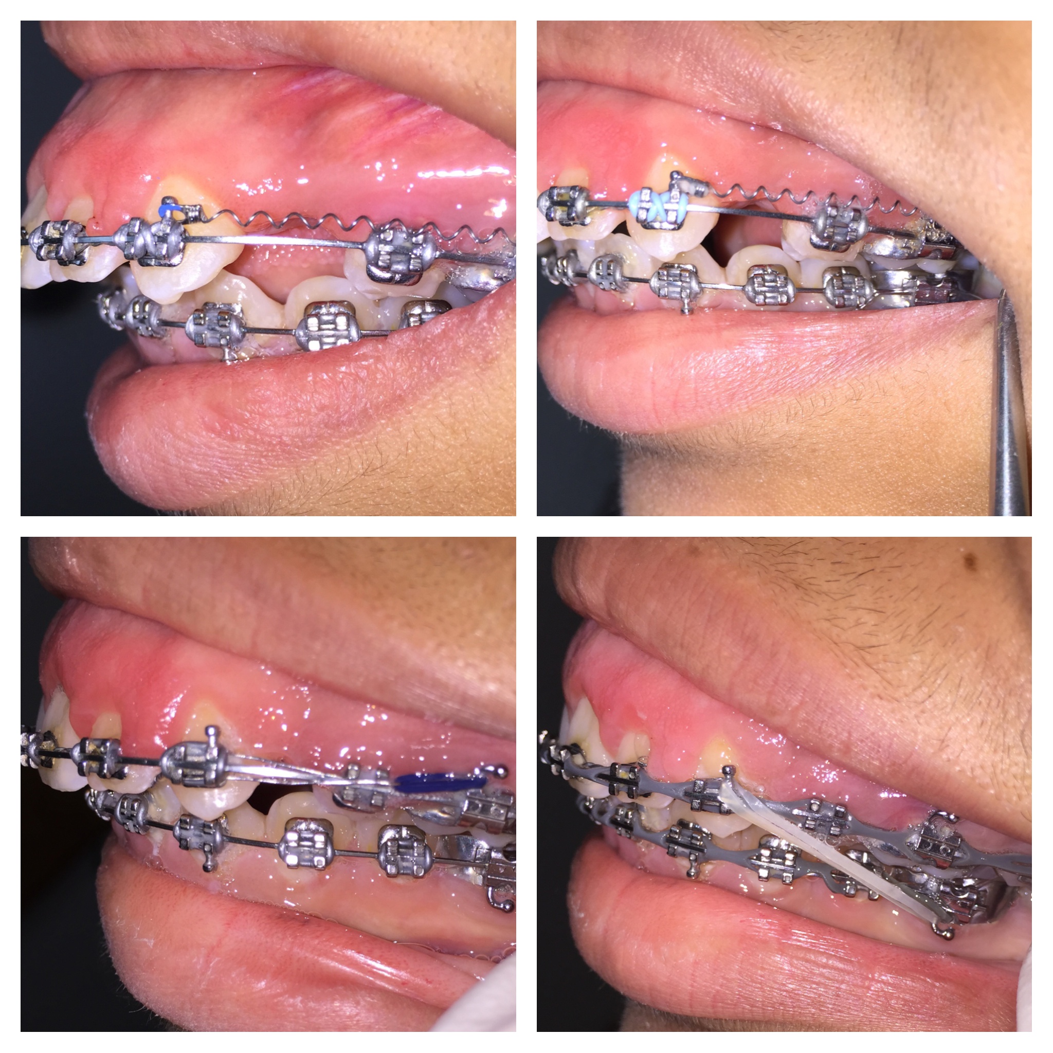 How To Correct Overbite With Braces Overbite Correction Without